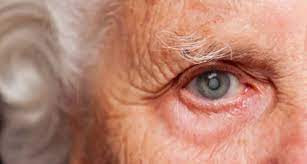 Mutirão de Cirurgias de Cataratas realiza o procedimento em mais 25 pessoas