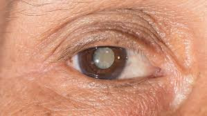 Nova visão: Ao longo de 3 anos, Secretaria de Saúde realizou 465 cirurgias de catarata reduzindo sobremaneira a fila