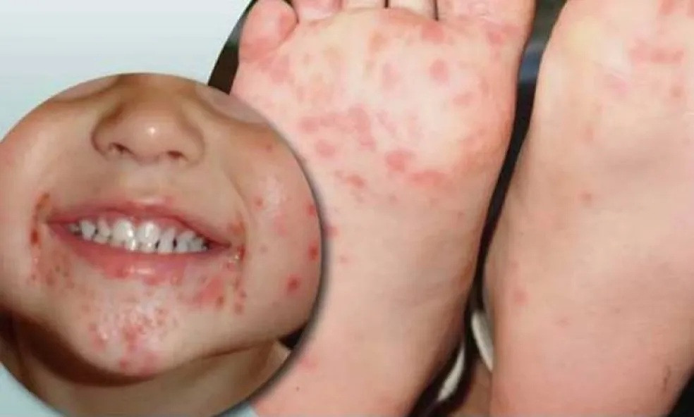 DOENÇA CHAMADA MÃO, PÉ E BOCA TEM SIDO A PREOCUPAÇÃO DOS PAIS JÁ QUE AFETA CRIANÇAS NAS ESCOLAS