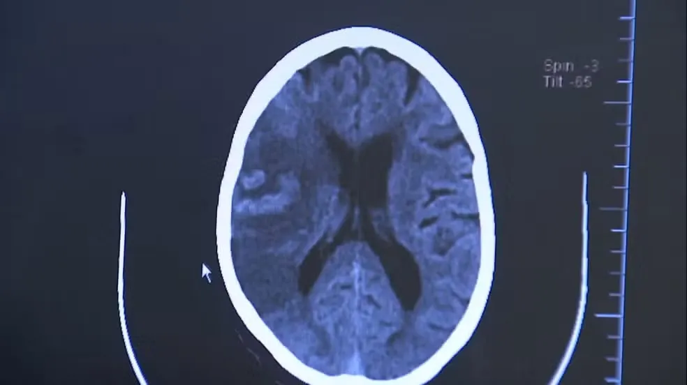 AVC TIRA A VIDA DE UM BRASILEIRO A CADA SEIS MINUTOS; 80% DOS CASOS PODERIAM SER EVITADOS